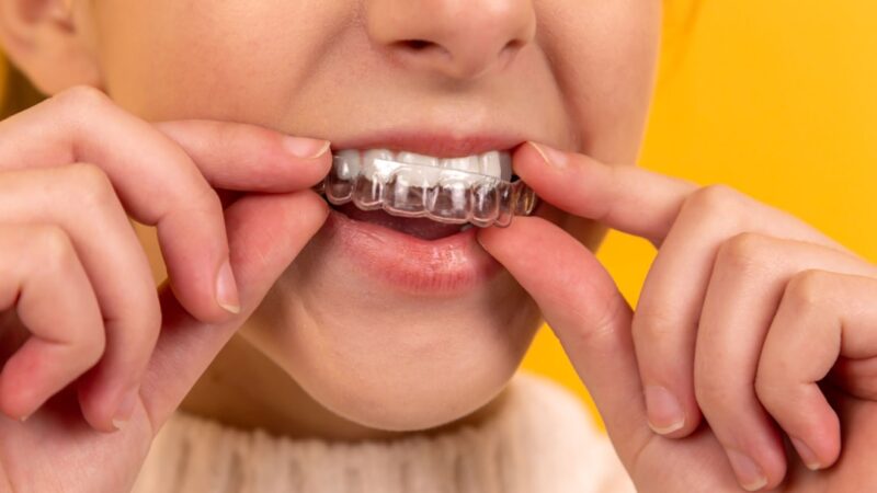 Invisalign: Den Diskrete Løsning for Et Smukt Smil